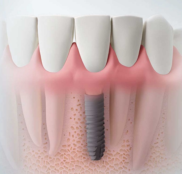 implant surface
